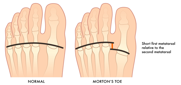 What Causes Forefoot Pain? Walking Mobility Clinics photo pic